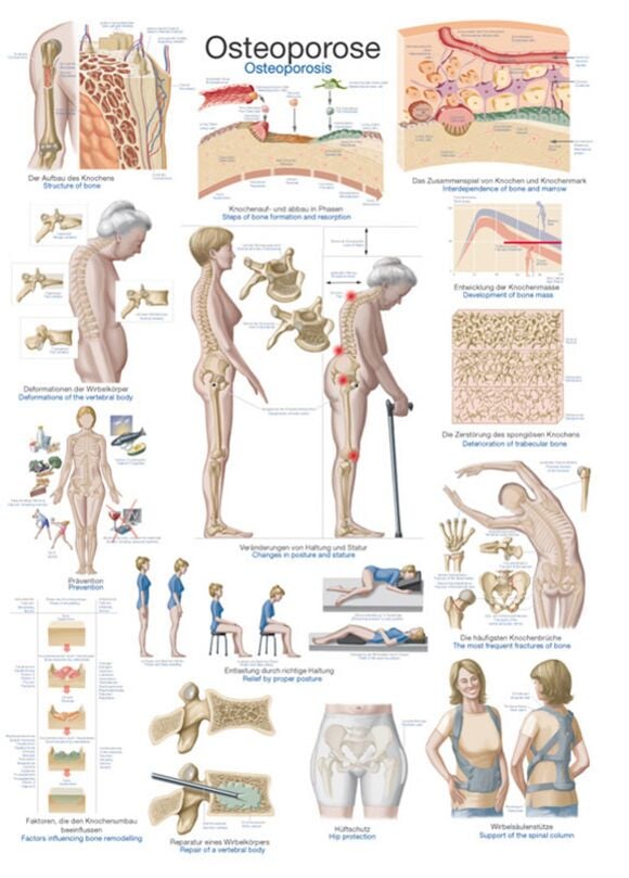Instructional Chart - Osteoporosis