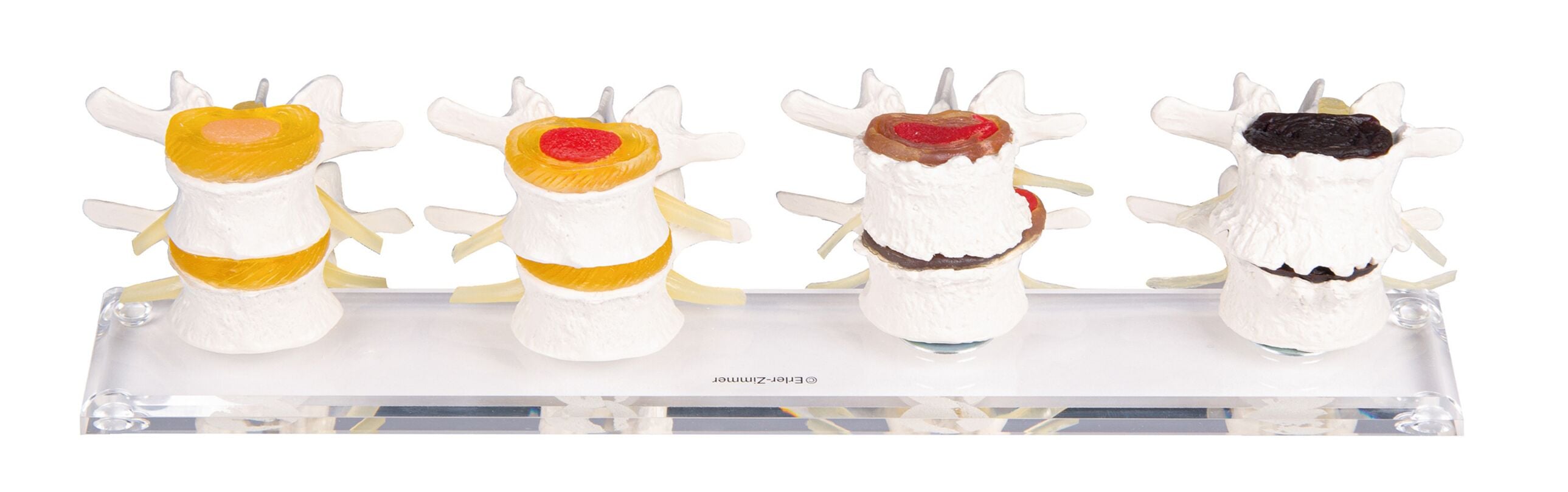 Erler-Zimmer Stages of Intervertebral Disc Damage