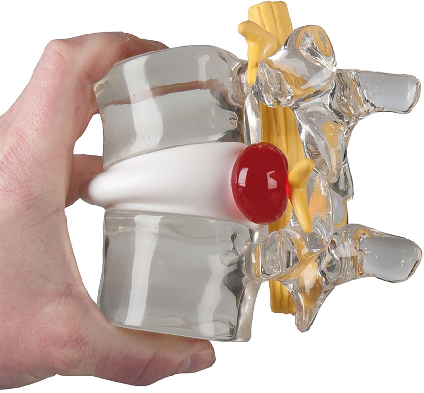 Erler-Zimmer Disc Herniation Simulator