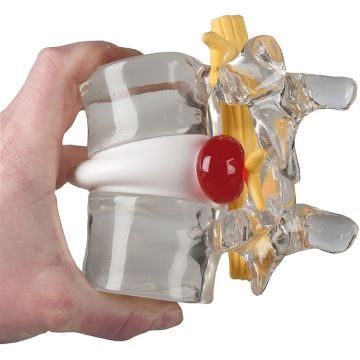 Erler-Zimmer Disc Herniation Simulator