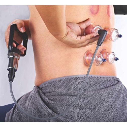 AcuTop® Cupping Set