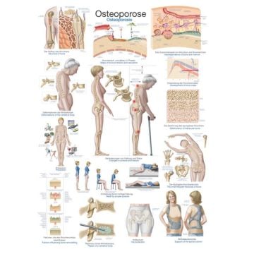 Instructional Chart - Osteoporosis