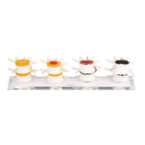 Erler-Zimmer Stages of Intervertebral Disc Damage