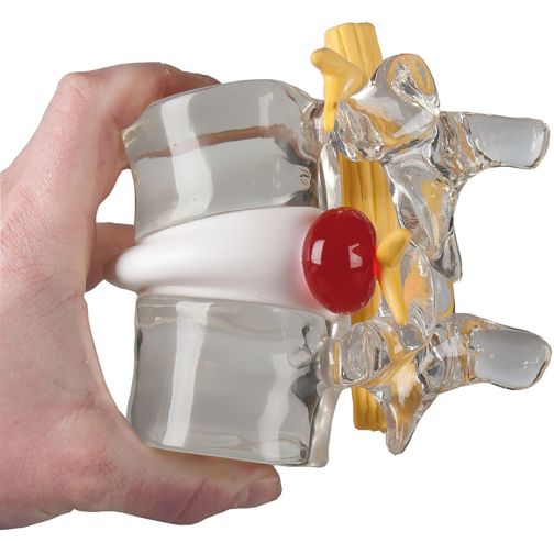Erler-Zimmer Disc Herniation Simulator