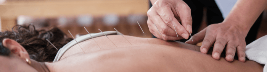 Acupuncture Needles